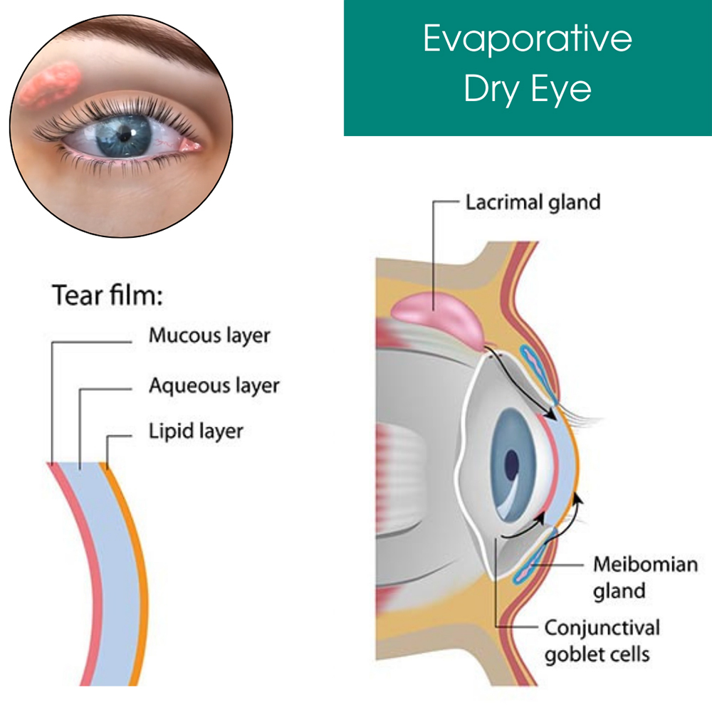Dry Eyes/Keratoconjunctivitis Sicca (KCS) : Eye Physicians