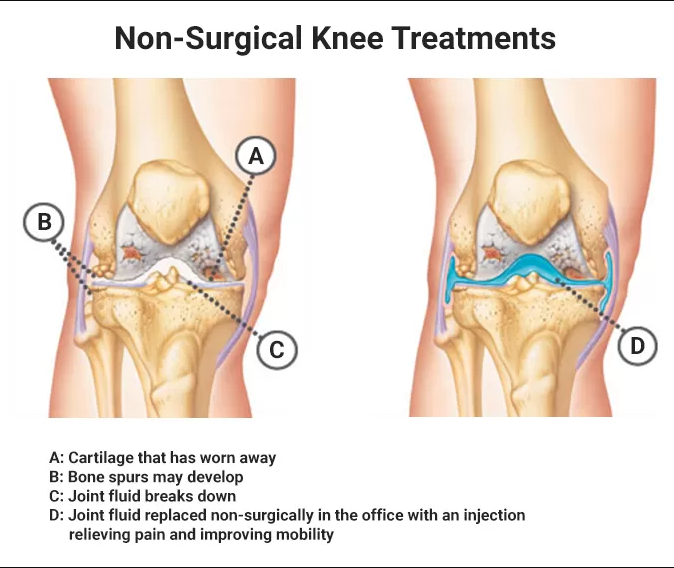 Knee Pain Treatment NYC | Knee Pain Doctors in Manhattan, New York : New York Pain Care (New York)